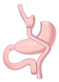 Lap Roux-en-Y Gastric Bypass