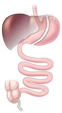 Lap Sleeve Gastrectomy