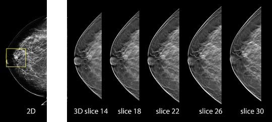 3D Mammography For Early Breast Cancer Detection Summa Health