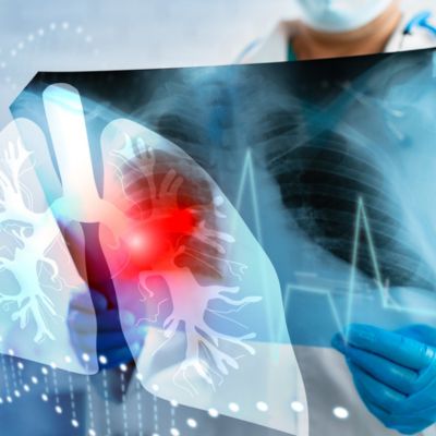 Doctor view lung xray