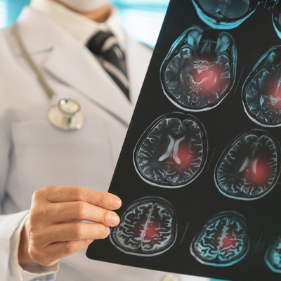 Doctor radiology looking stroke brain x-ray image for diagnose ischemic stroke or cerebrovascular disease at hospital
