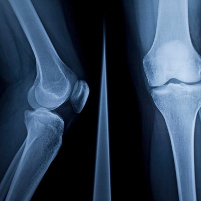 An x-ray of a person's knees