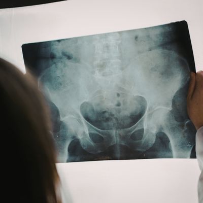 a healthcare professional looking at a pelvic x-ray