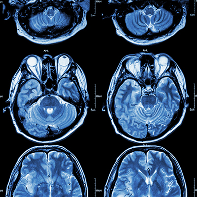 Thrombectomy