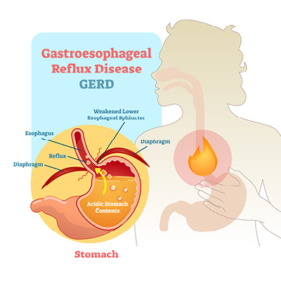 Infographic showing the stomach and where GERD occurs