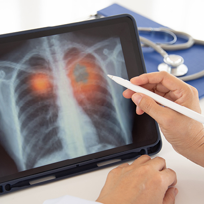 X-ray of lungs with highlighted nodes
