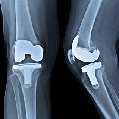 X-ray of knee post replacement surgery 