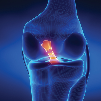 picture of knee with the ACL highlighted and torn