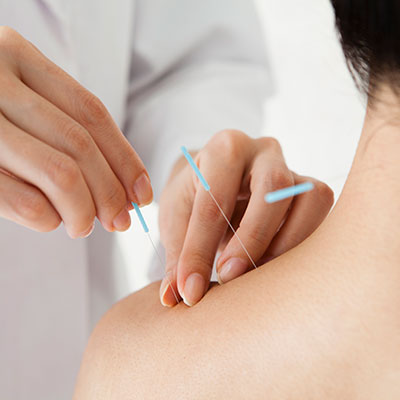 Doctor performing acupuncture