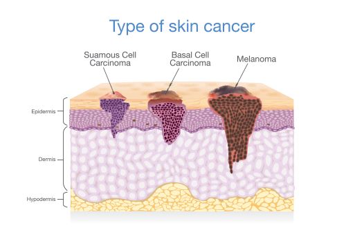 Types of Skin Cancer