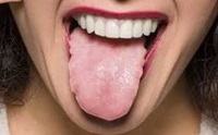 Enlarged Tongue