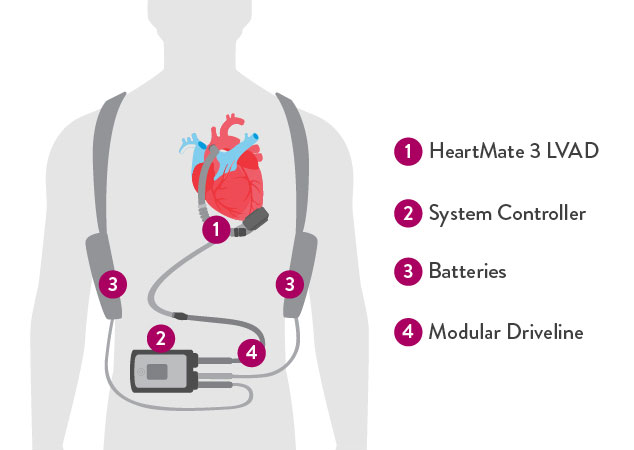 LVAD procedure and how it works