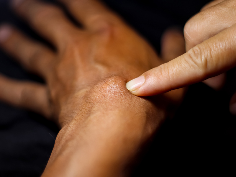 Hand Cyst