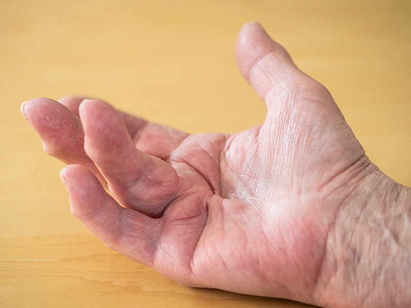 Dupuytren's contracture 