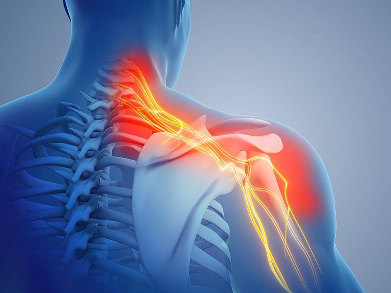 Illustration of nerve injury on shoulder