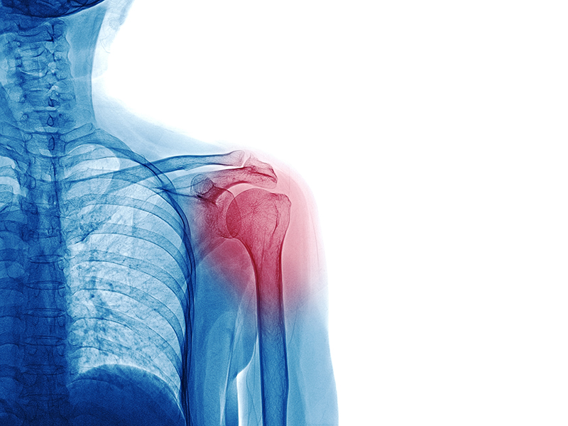 Xray of Shoulder Fracture