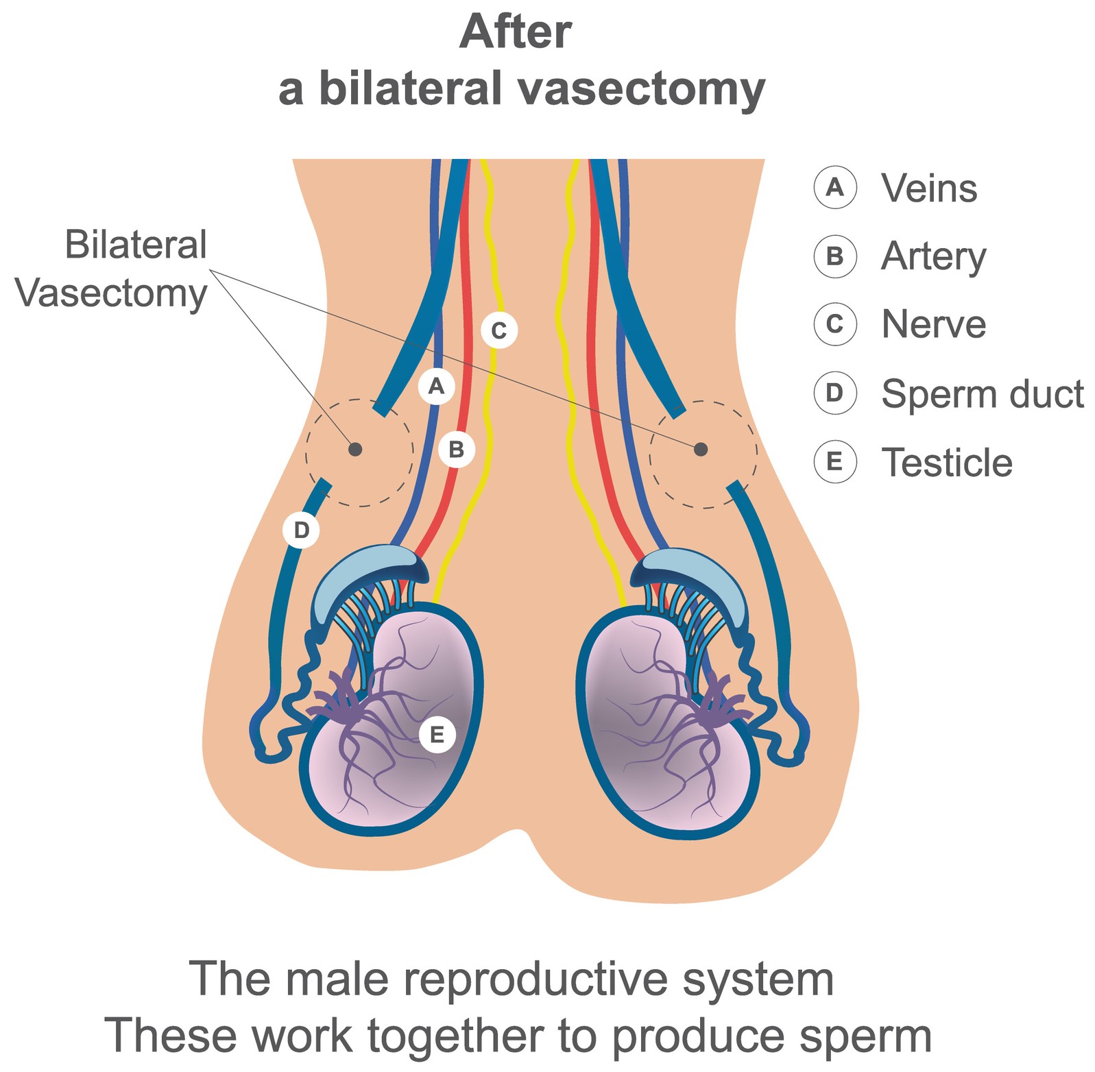 Vasectomy